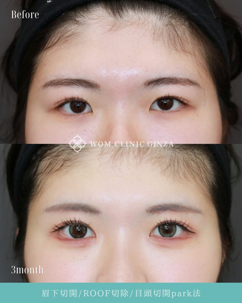 『瞼の重さを取るのに、眉下切開が最強な理由。』の画像