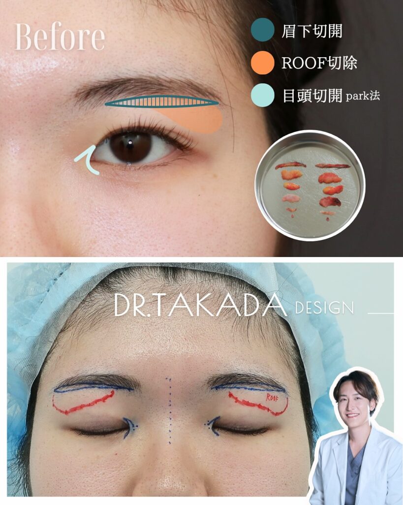 『瞼の重さを取るのに、眉下切開が最強な理由。』の画像