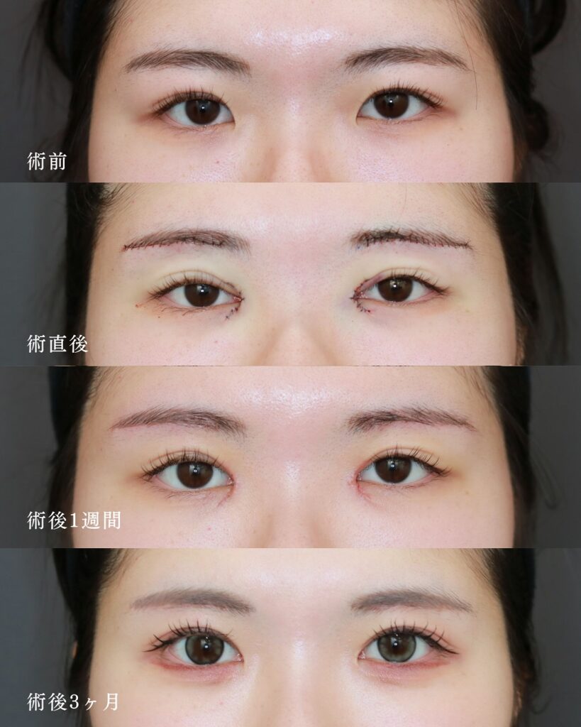 『瞼の重さを取るのに、眉下切開が最強な理由。』の画像
