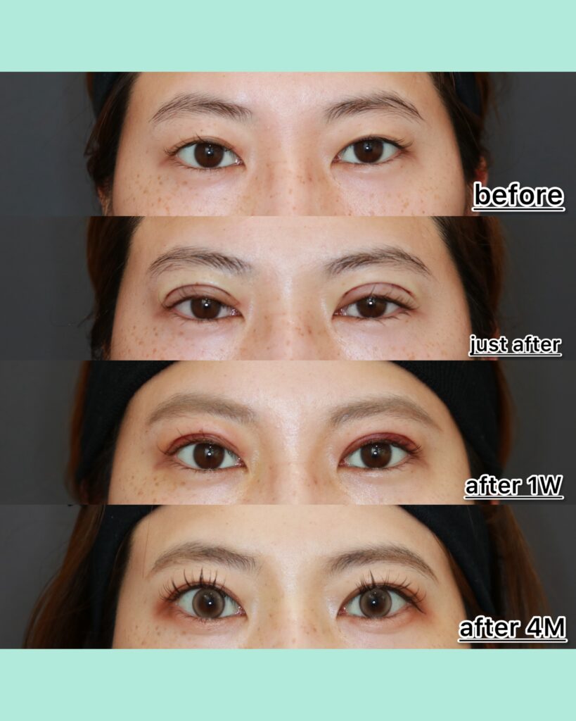 『あなたは全切開と気づきますか?自然さを突き詰めた全切開』の画像