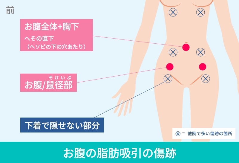 太もも・お尻の脂肪吸引の傷跡