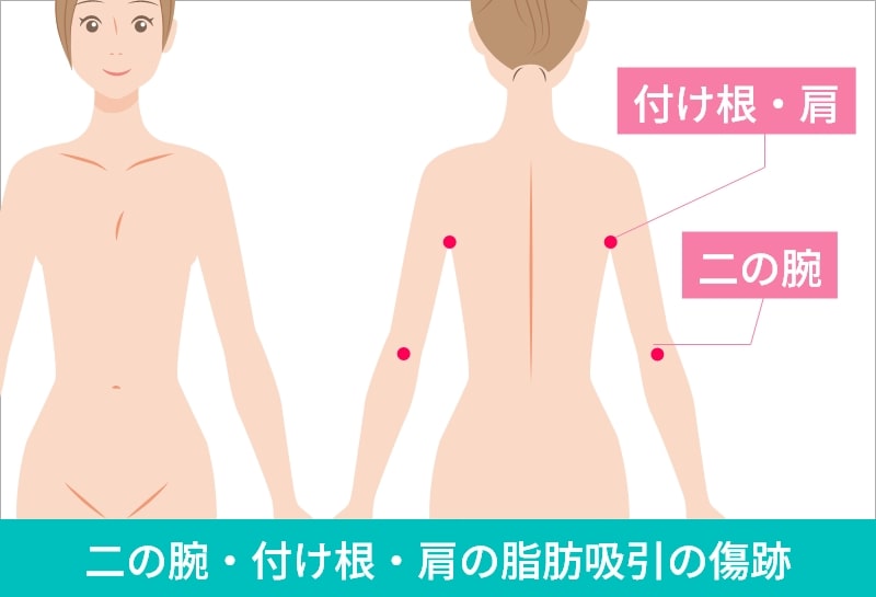 二の腕・肩・付け根の脂肪吸引の傷跡