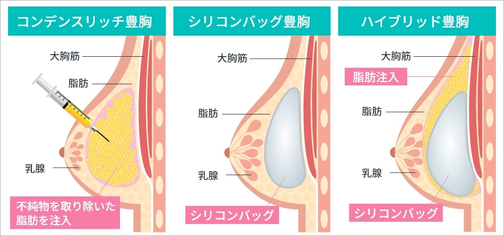 豊胸手術の種類