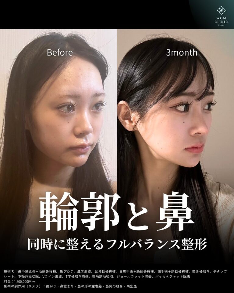 鼻フル整形の術前と3ヶ月後のビフォーアフター