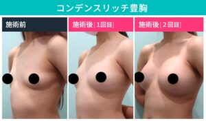 コンデンスリッチ豊胸