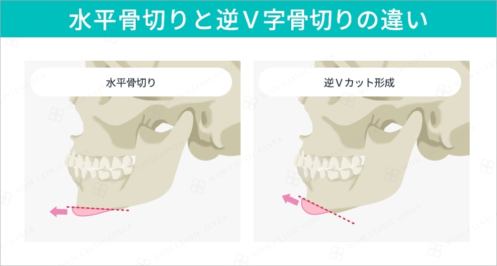 水平骨切りと逆V字骨切りの違い