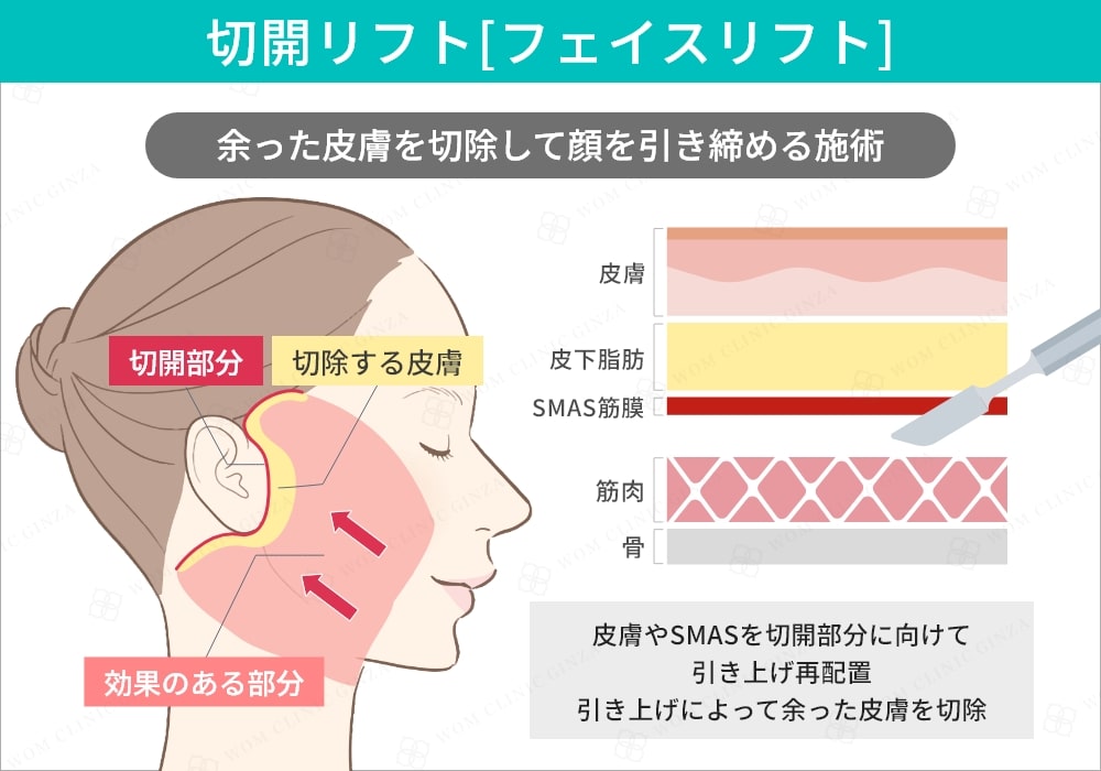 切開リフト(フェイスリフト)