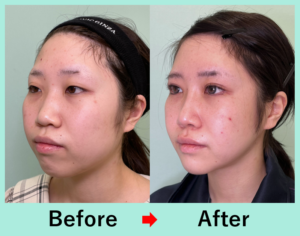 輪郭3点骨切り手術+顔の脂肪吸引+バッカルファット除去の症例写真