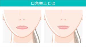 口角挙上