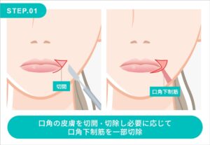 口角挙上の施術方法 STEP.01