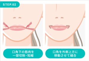 口角挙上の施術方法 STEP.02