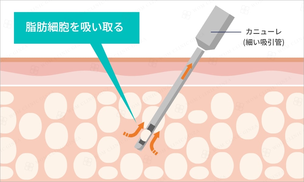 カニューレで脂肪細胞を吸い取る様子