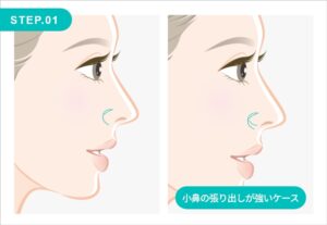 鼻翼挙上の施術方法 STEP.01