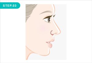 鼻翼挙上の施術方法 STEP.03