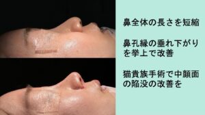 鼻翼挙上の症例写真