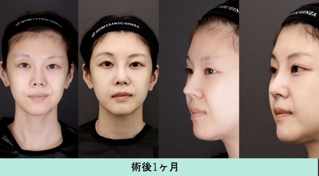 韓国で鼻整形を受けた女性の術後1ヶ月