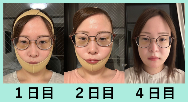 骨切り後の経過写真1日目から4日目