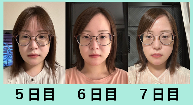 骨切り後の経過写真5日目から1週間目