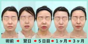 外板切除の症例写真