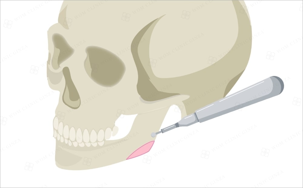 外板切除の施術方法