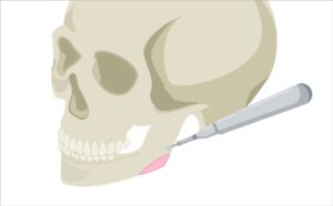 外板切除の施術方法