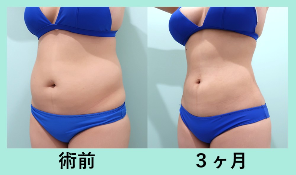 お腹・背中・腰の脂肪吸引