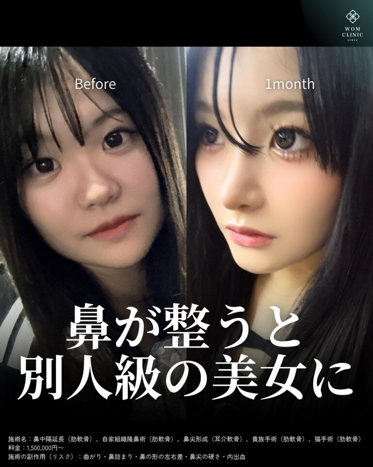 似合わせ鼻の術前と1ヶ月後のビフォーアフター