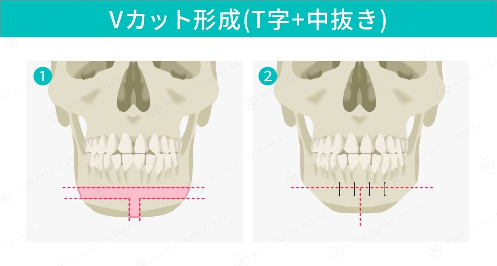 Vカット形成（T字＋中抜き）