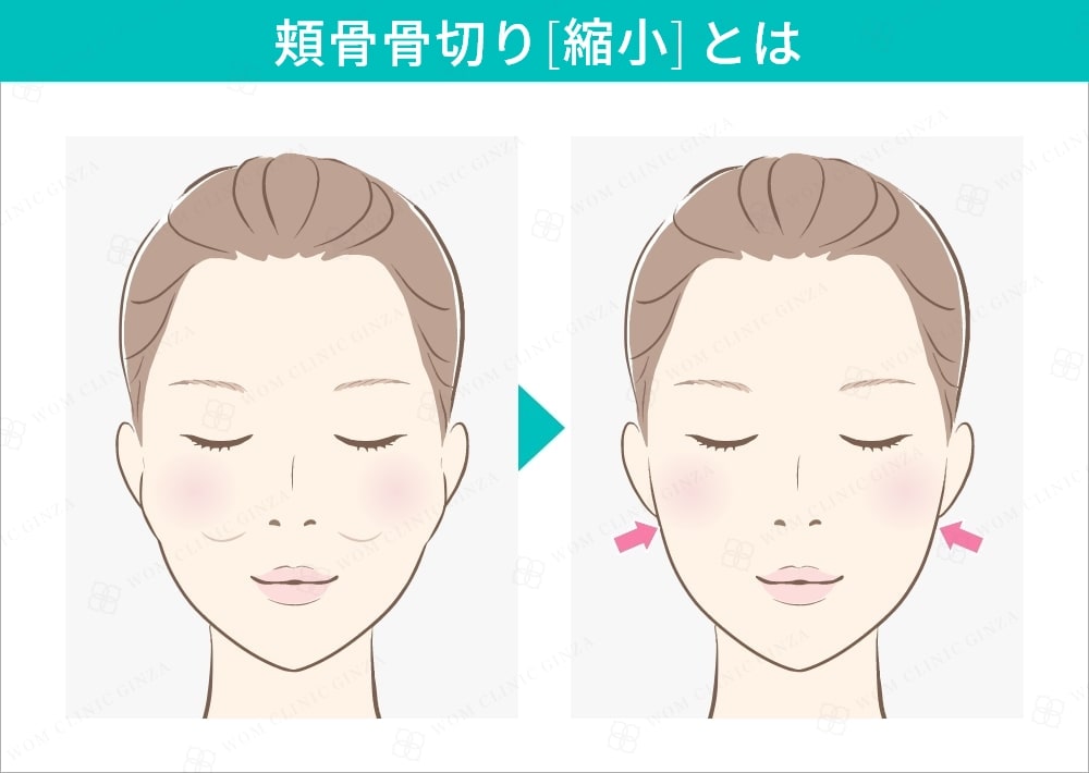 頬骨骨切り（縮小）とは