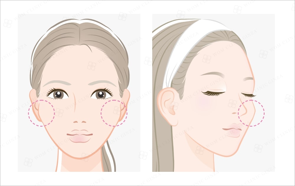 頬骨骨切りで期待できる効果