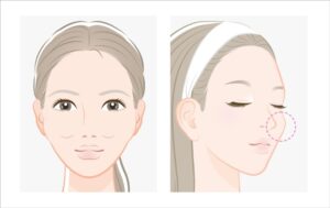 頬骨骨切りで期待できる効果