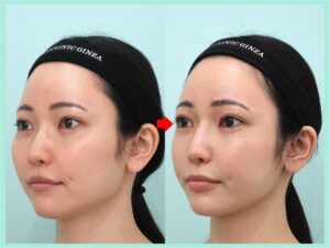 頬骨骨切りの症例写真