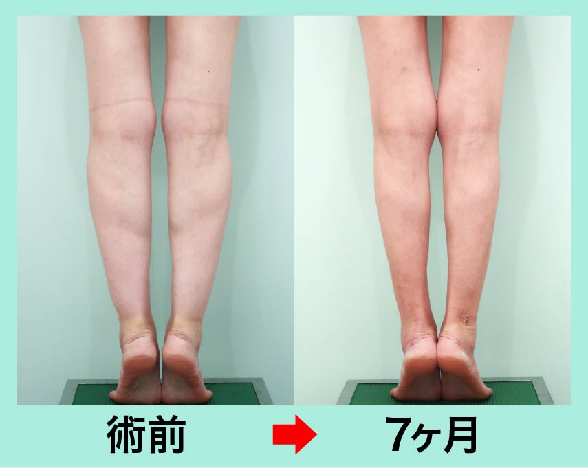『え?、前スネ? どこもやっていない下腿全周、ふくらはぎ~前脛骨部(スネ)まで全周の脂肪吸引!』の画像