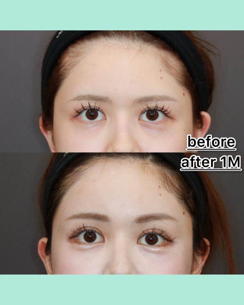 『二重整形はむしろ禁忌!前額リフトの絶対的適応とは』の画像