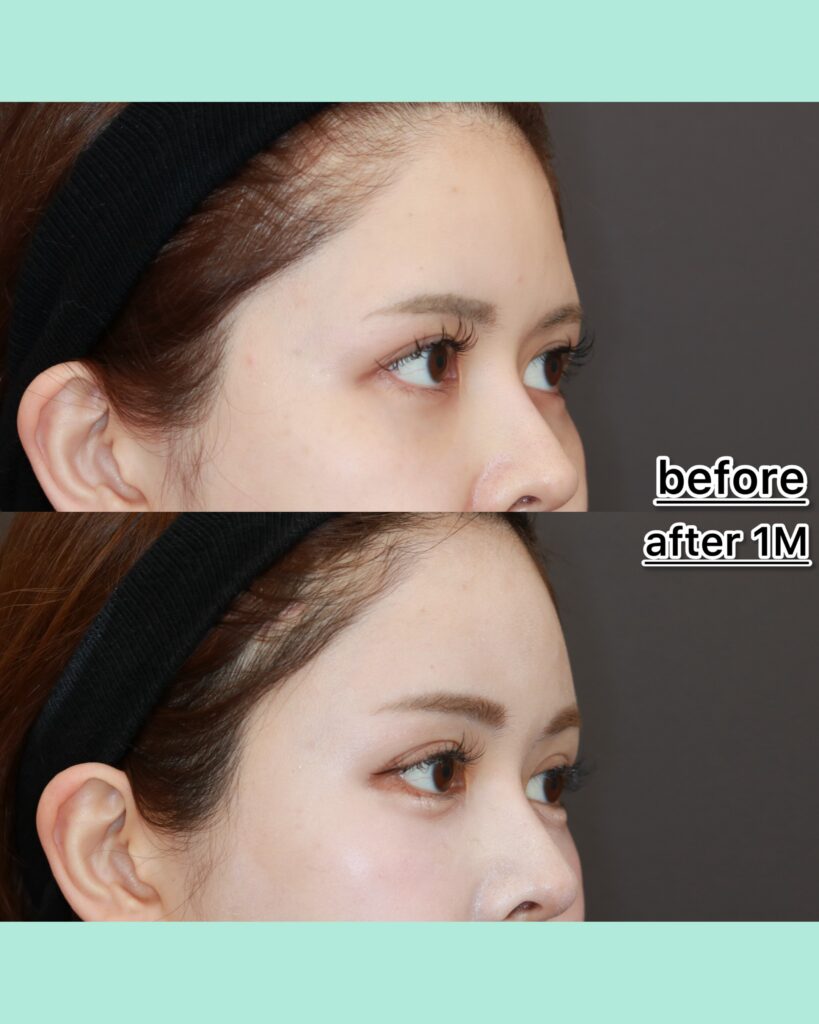 『二重整形はむしろ禁忌!前額リフトの絶対的適応とは』の画像