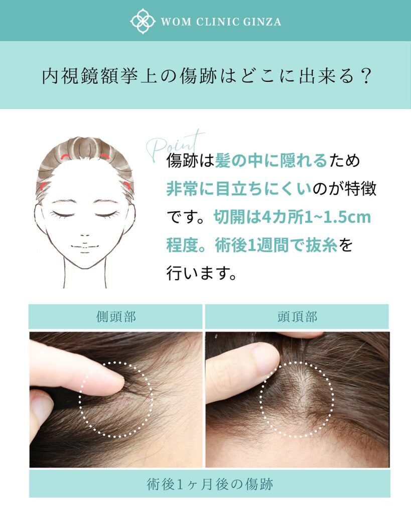 『目元が明るく変わる!内視鏡額挙上(前額リフト)』の画像