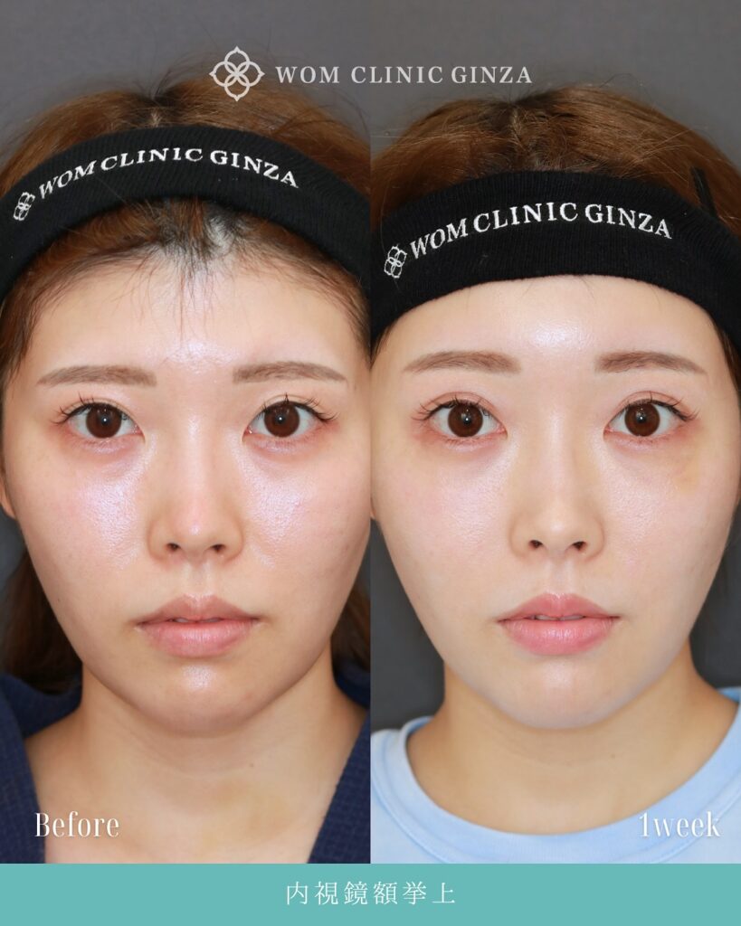 『目元が明るく変わる!内視鏡額挙上(前額リフト)』の画像