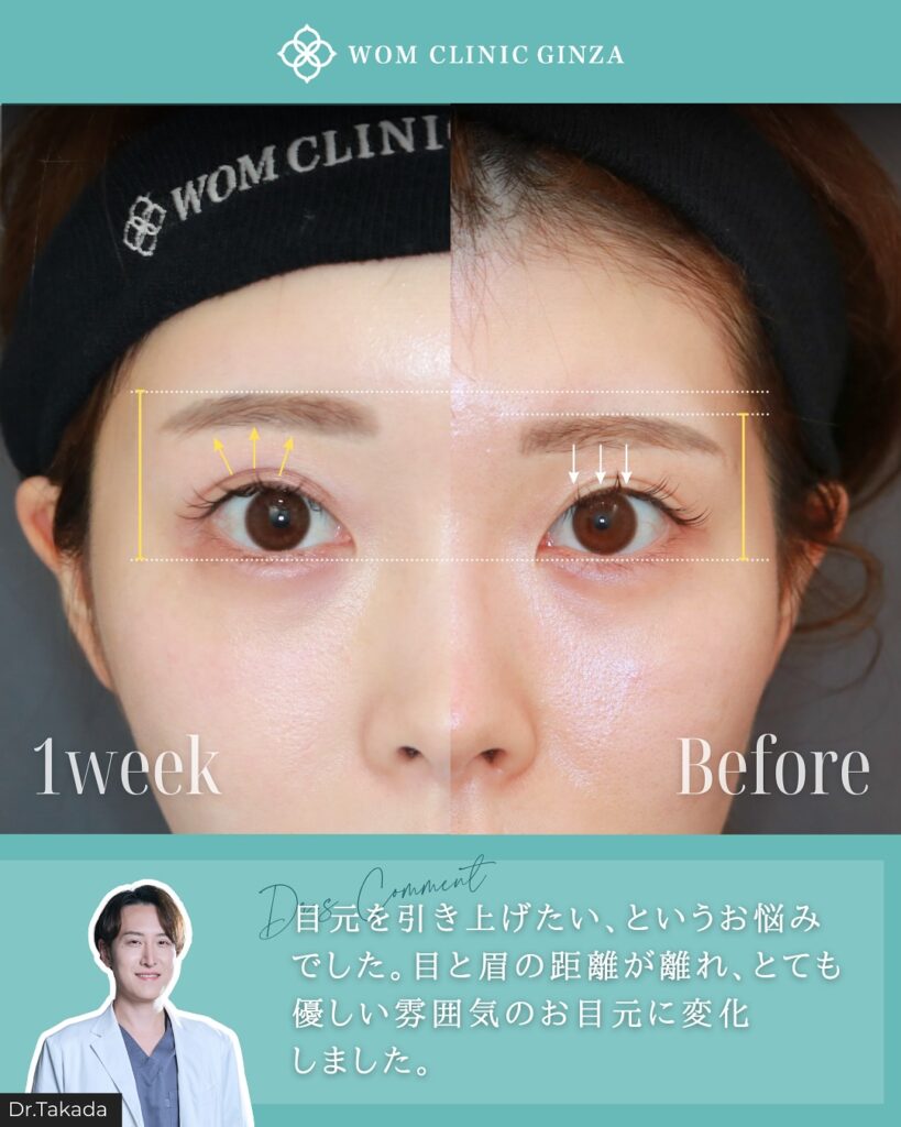 『目元が明るく変わる!内視鏡額挙上(前額リフト)』の画像