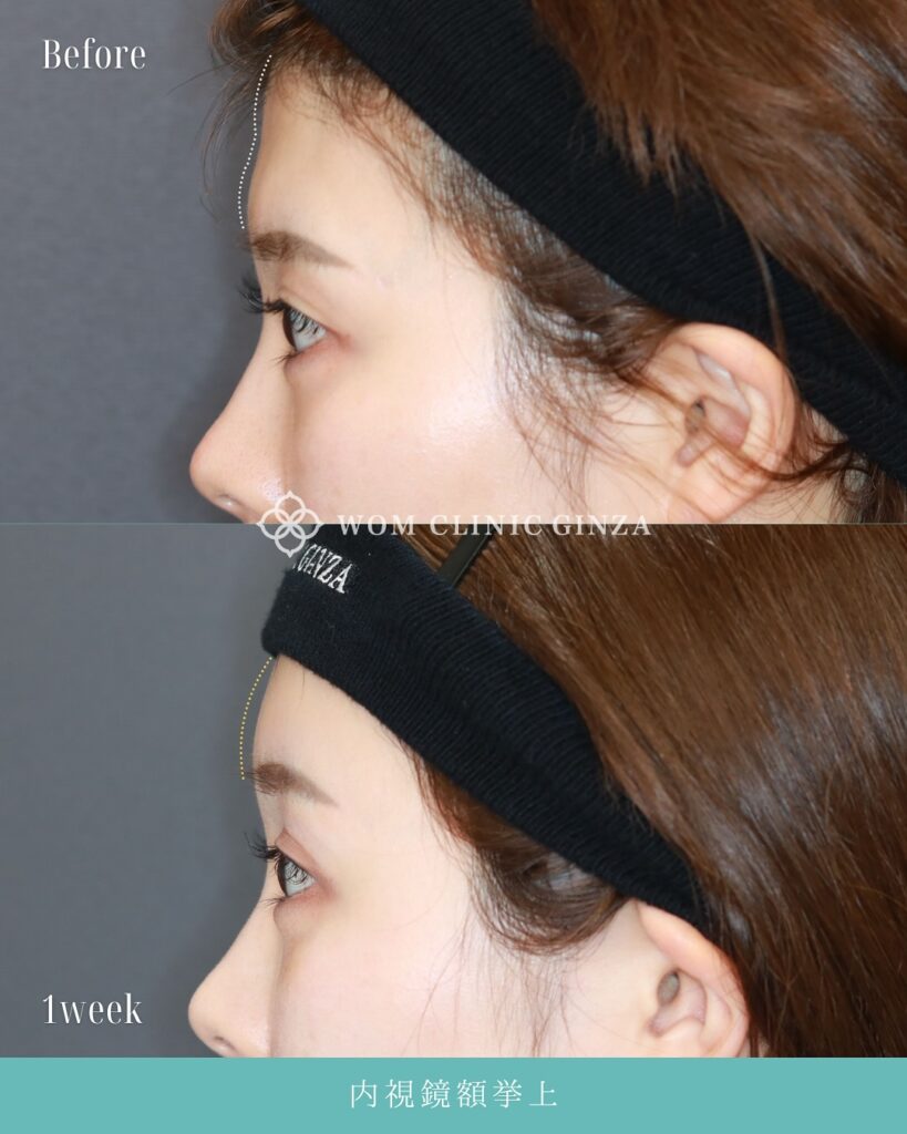 『目元が明るく変わる!内視鏡額挙上(前額リフト)』の画像