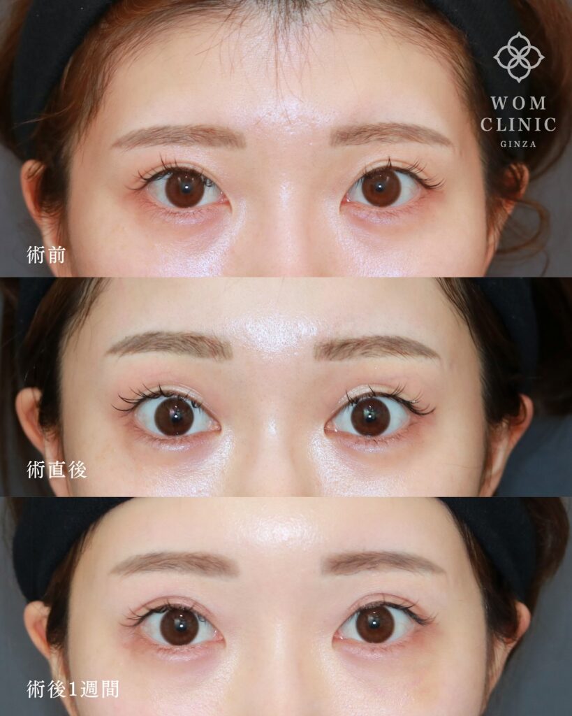 『目元が明るく変わる!内視鏡額挙上(前額リフト)』の画像