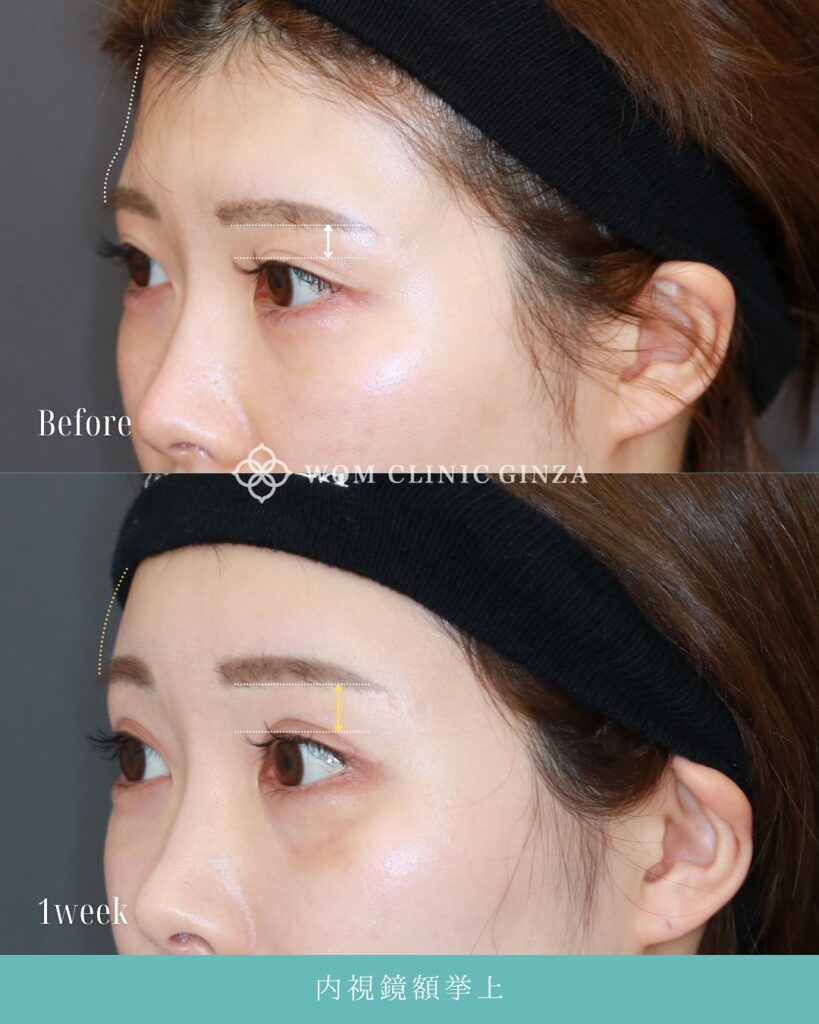 『目元が明るく変わる!内視鏡額挙上(前額リフト)』の画像
