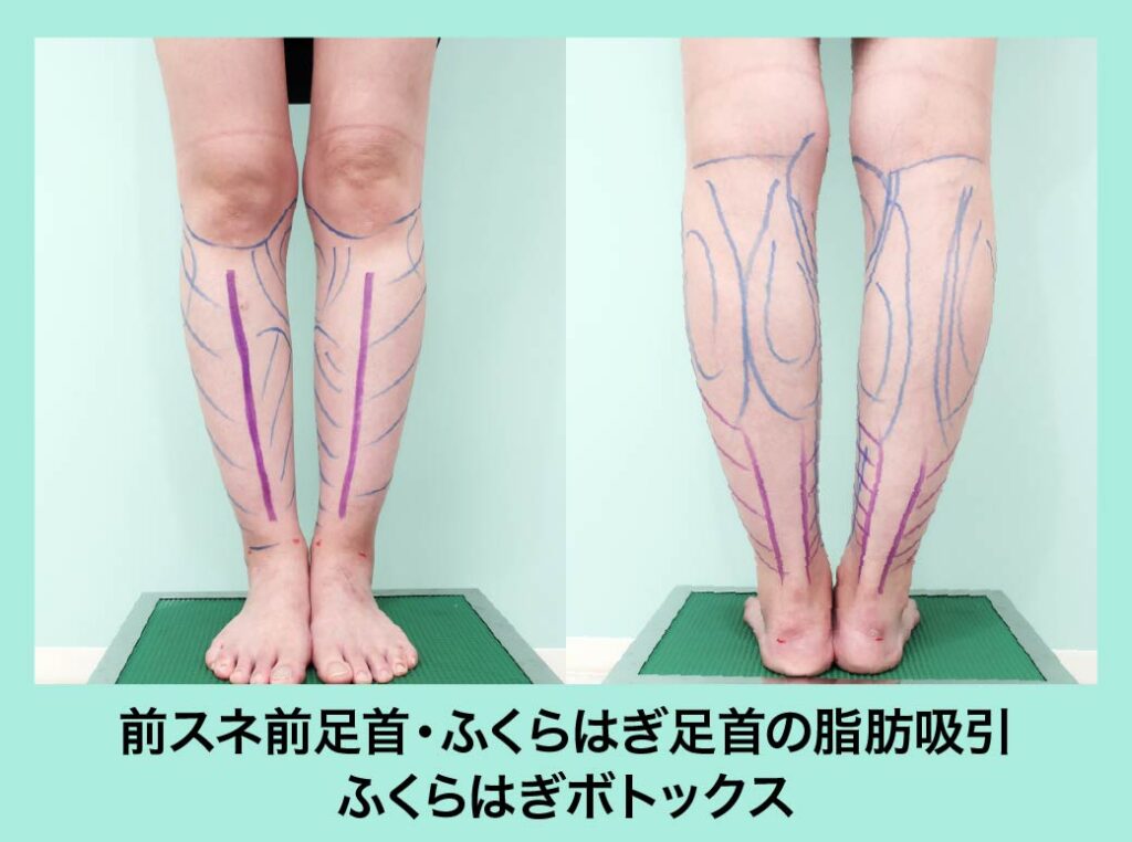 脂肪吸引のデザイン