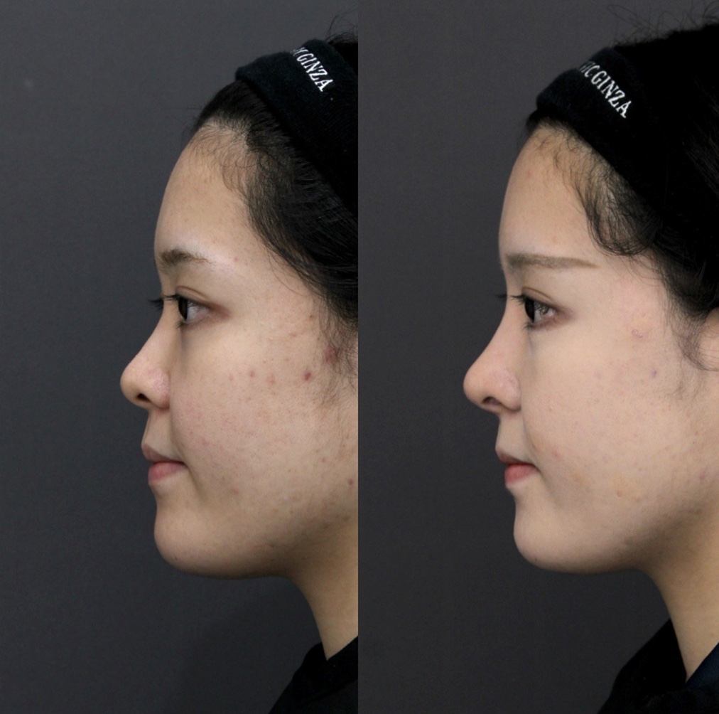 『初回鼻整形:鼻の穴の見え方と高さを整えて、上品な立体感へ』の画像