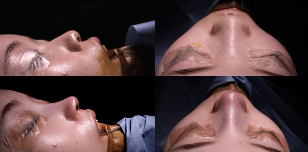 『初回鼻整形:自家組織のみで高さと立体感を整えた症例』の画像