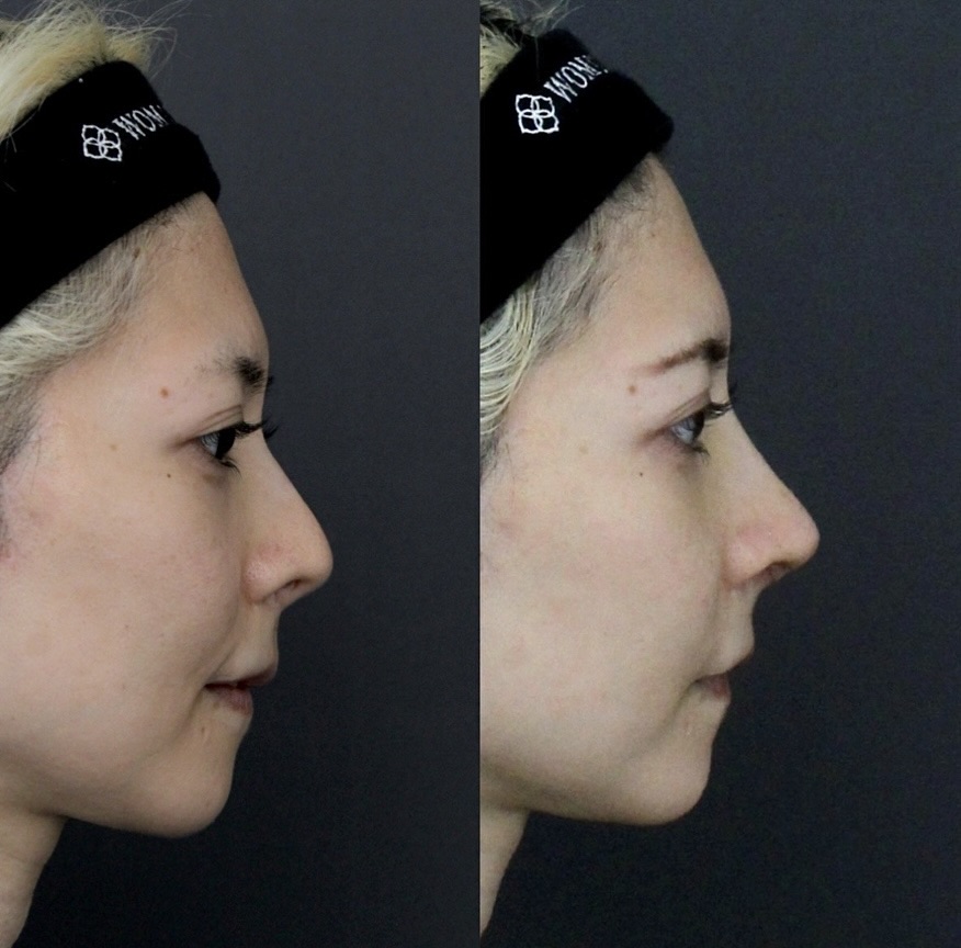 『他院修正:吊り上がった鼻先を自然な角度へ』の画像