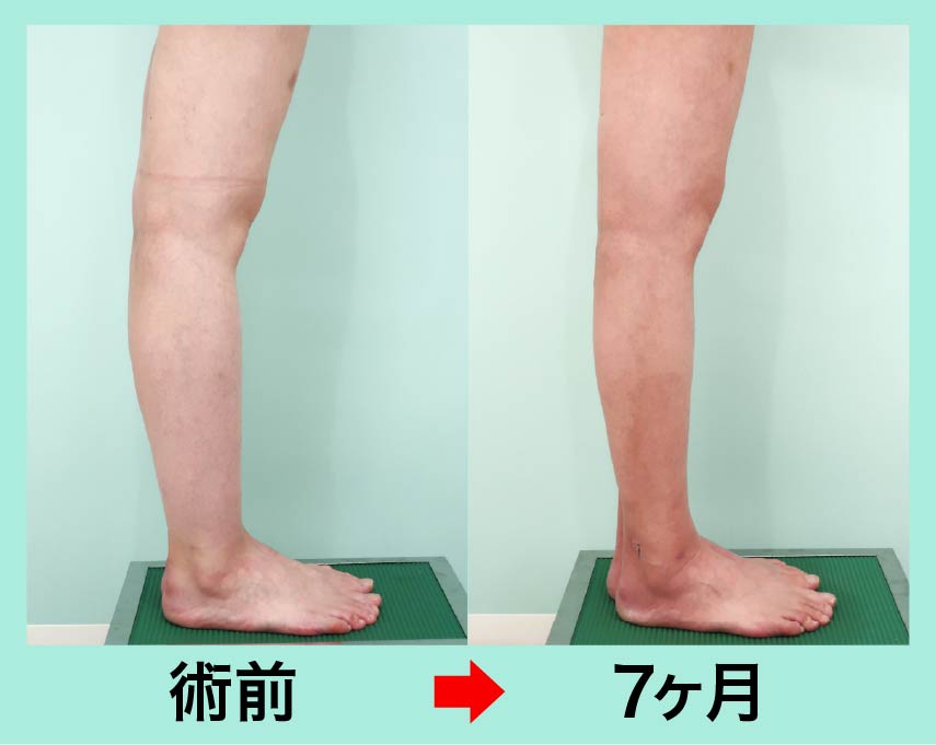 前スネ・ふくらはぎ足首の脂肪吸引