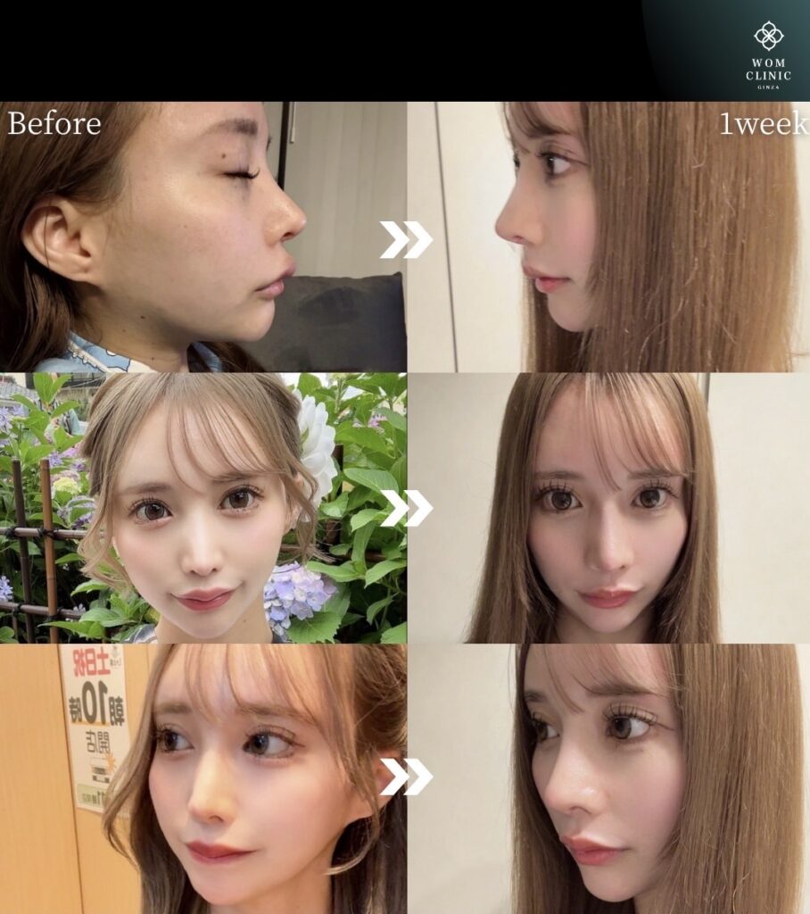 『他院修正:鼻の穴の左右差・曲がり・鼻通りの改善を同時に行った症例』の画像