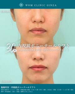 『ポニーテールリフトで中顔面を引き上げる|切開フェイスリフトとの違いと効果』の画像