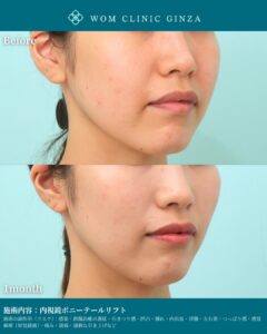 『ポニーテールリフトで中顔面を引き上げる|切開フェイスリフトとの違いと効果』の画像