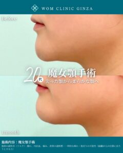 『先天的な魔女顎(Chin Ptosis)の治療|骨切りなしで改善する最新手術法』の画像